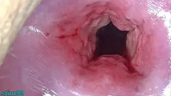 Uncensored Asian Cervix Stretching and Uterus Dilation with Penetration