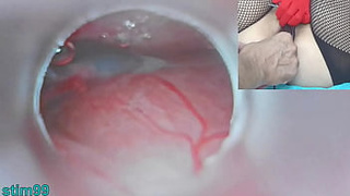 Oriental Insemination with Sperm into Uterus and Endoscope Online camera by Cervix to watch inside womb Uncensored