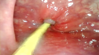 EXTREME ANAL SELF PERSPECTIVE. CAM INSIDE HER ASS-HOLE AS I POUND HER WITH MY LARGE ROD AND JIZZ DEEP INSIDE