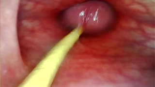 EXTREME ANAL SELF PERSPECTIVE. WEBCAM INSIDE HER BUTT-HOLE AS I POUND HER WITH MY MONSTROUS PENIS AND SPERM DEEP INSIDE