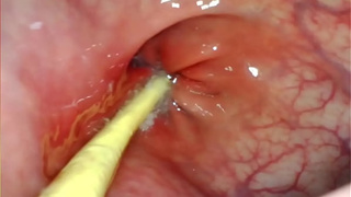 EXTREME ANAL SELF PERSPECTIVE. WEBCAM INSIDE HER BUTT-HOLE AS I POUND HER WITH MY HUMONGOUS PENIS AND SPUNK DEEP INSIDE
